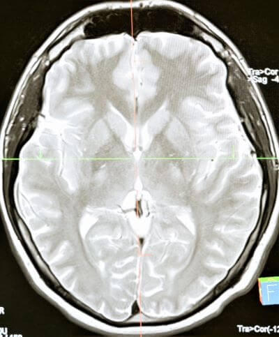 Pornography causes brain changes.